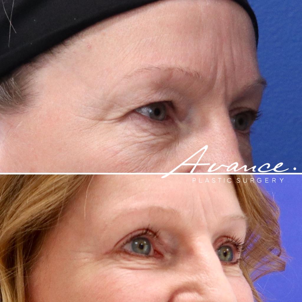 Before and After - Blefaroplastia superior
