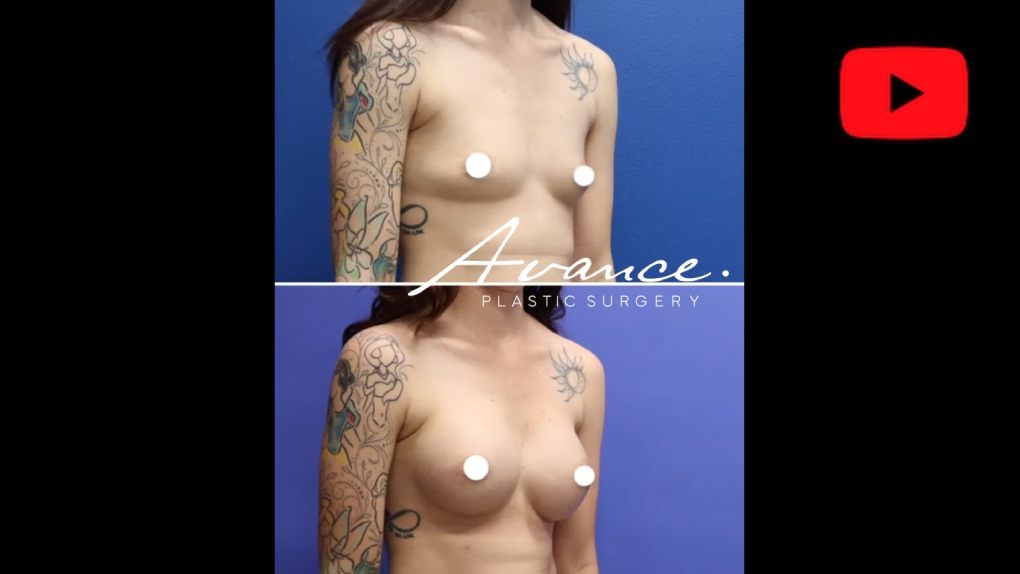 Reno Breast Augmentation | Tahoe Breast Implants | Avance Plastic Surgery Institute: Dr. Erez Dayan