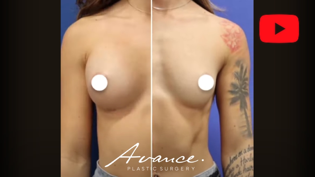 Breast Augmentation Before And After | Avance Plastic Surgery: Dr. Erez Dayan | Reno, Tahoe, NV