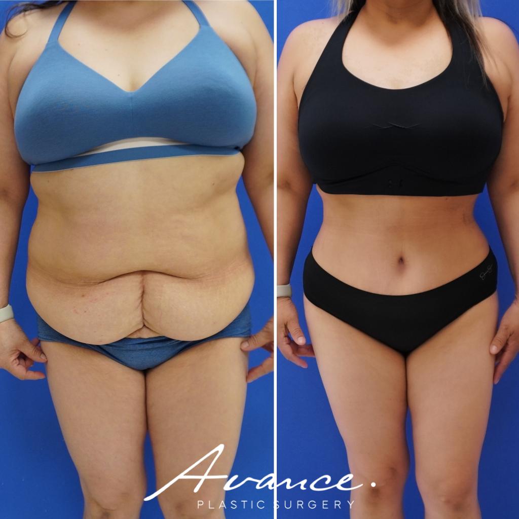Before and After - Abdominoplasty