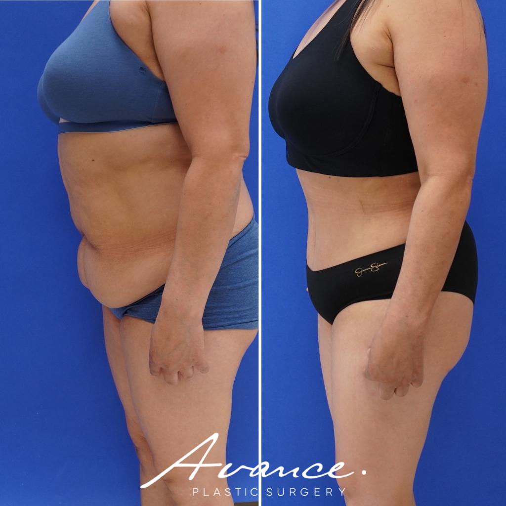Before and After - Abdominoplasty