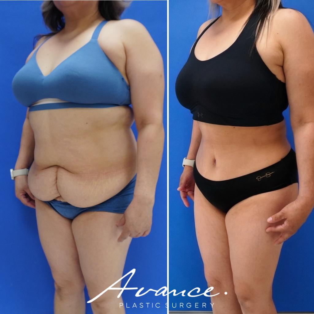 Before and After - Abdominoplasty
