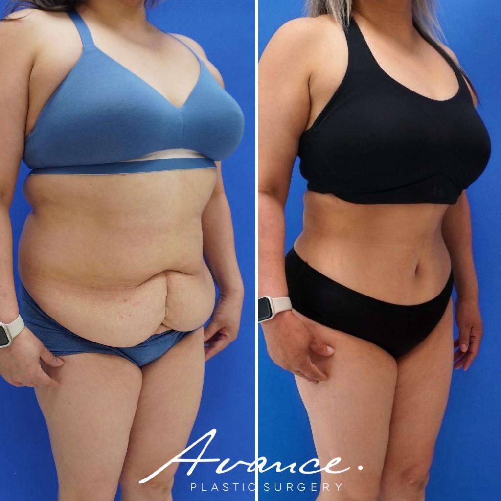 Before and After - Abdominoplasty