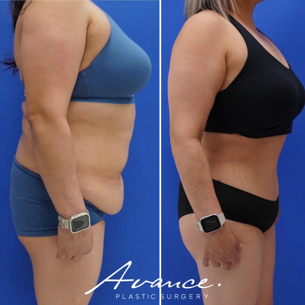 Before and After - Abdominoplasty