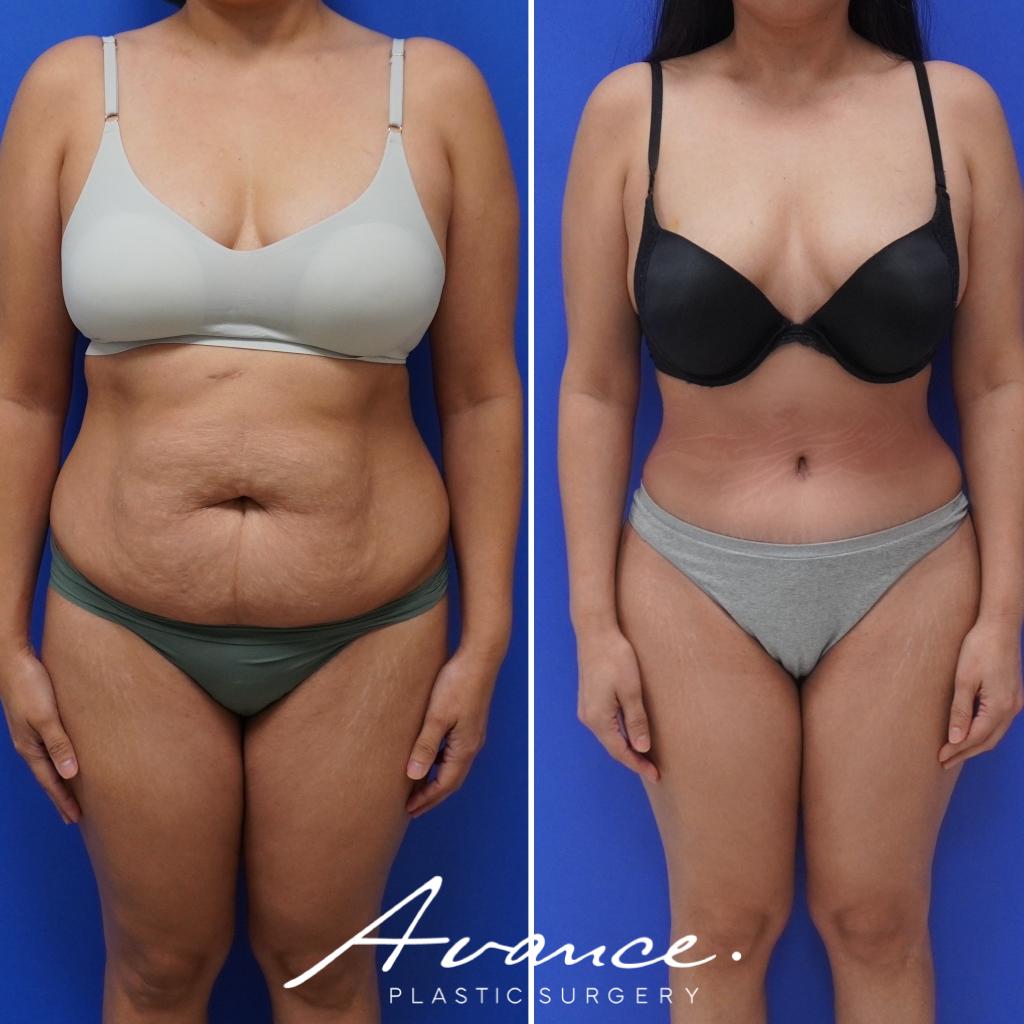 Before and After - Abdominoplasty