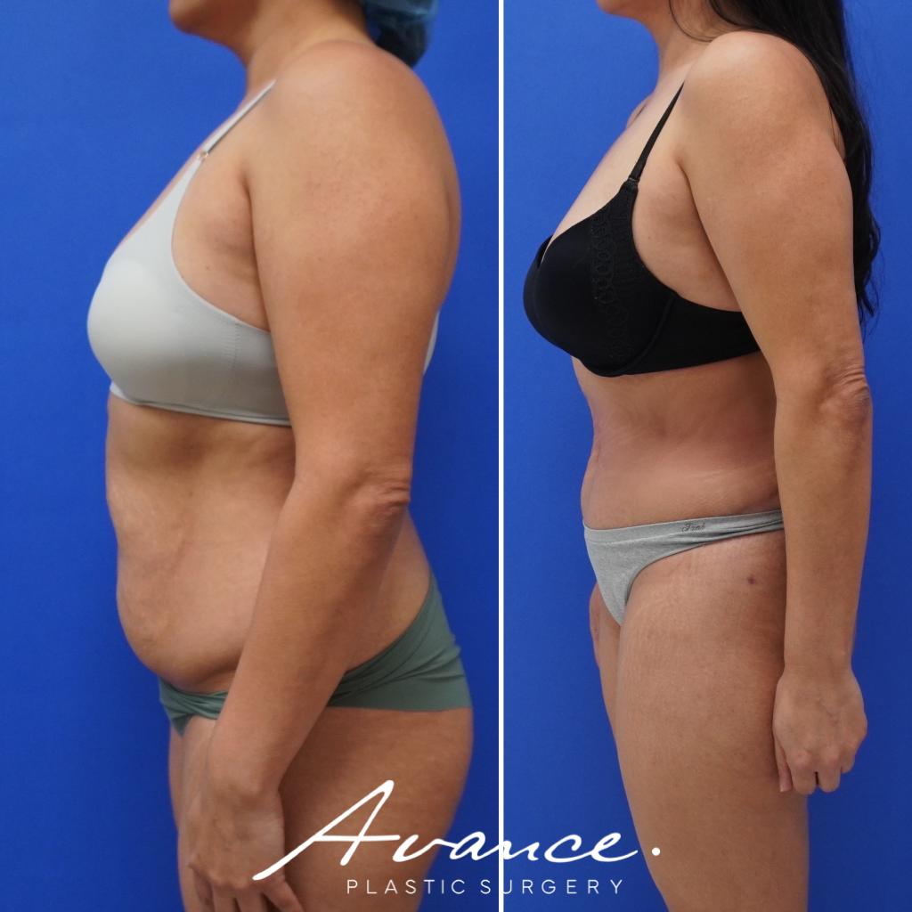 Before and After - Abdominoplasty