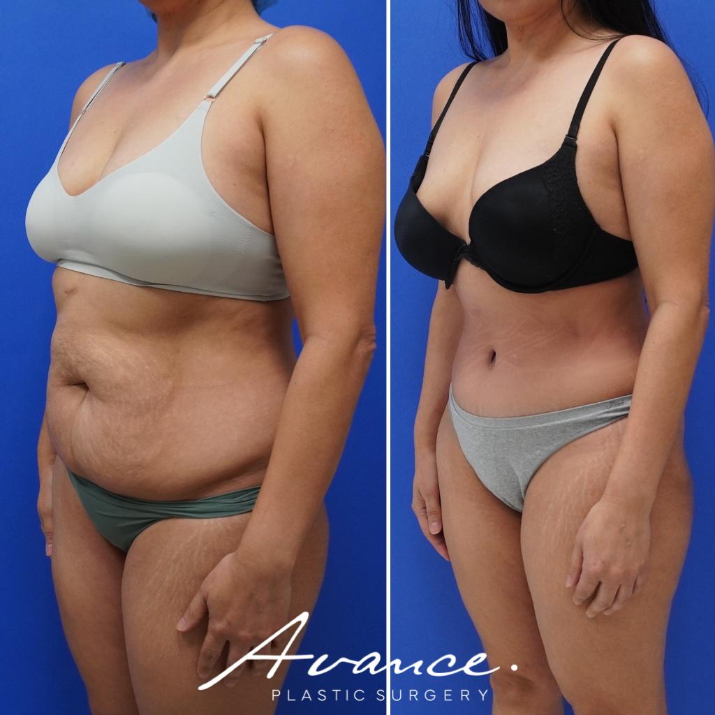Before and After - Abdominoplasty