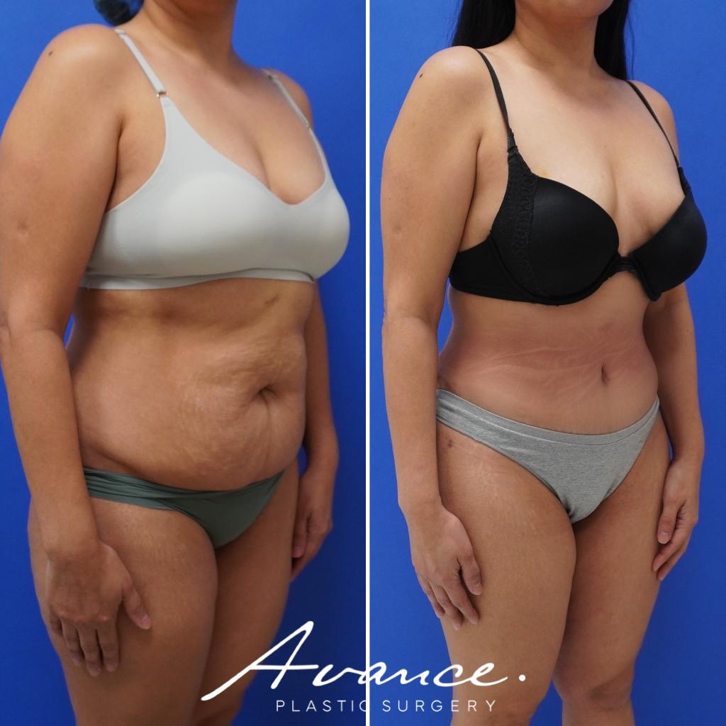 Before and After - Abdominoplasty