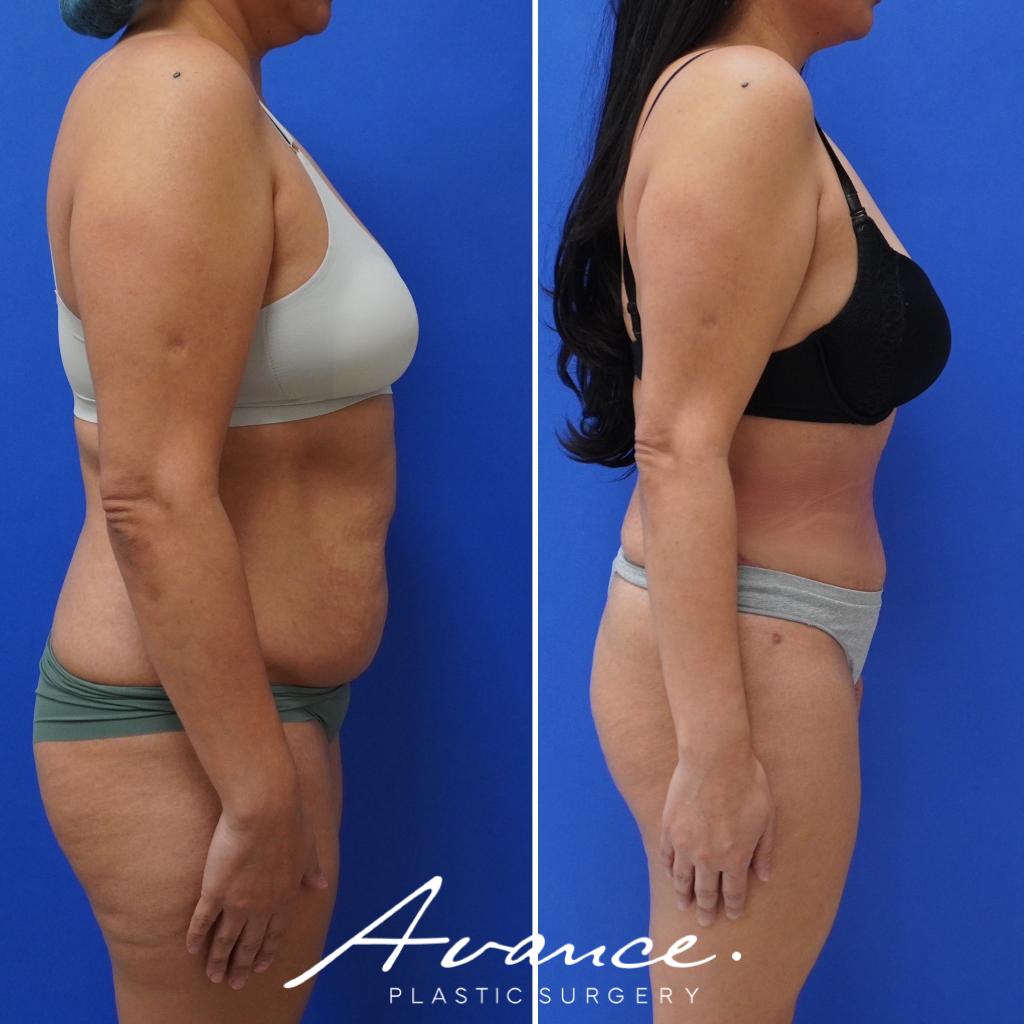 Before and After - Abdominoplasty