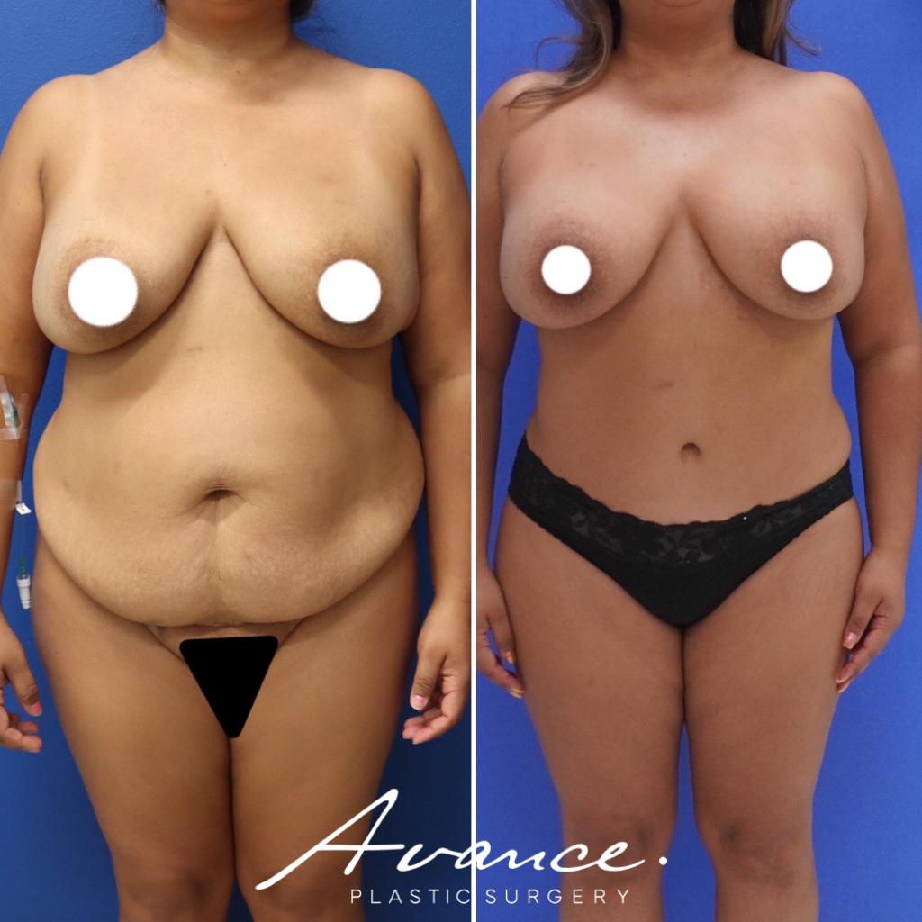Before and After - Abdominoplasty