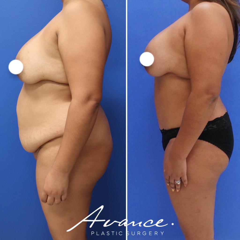 Before and After - Abdominoplasty