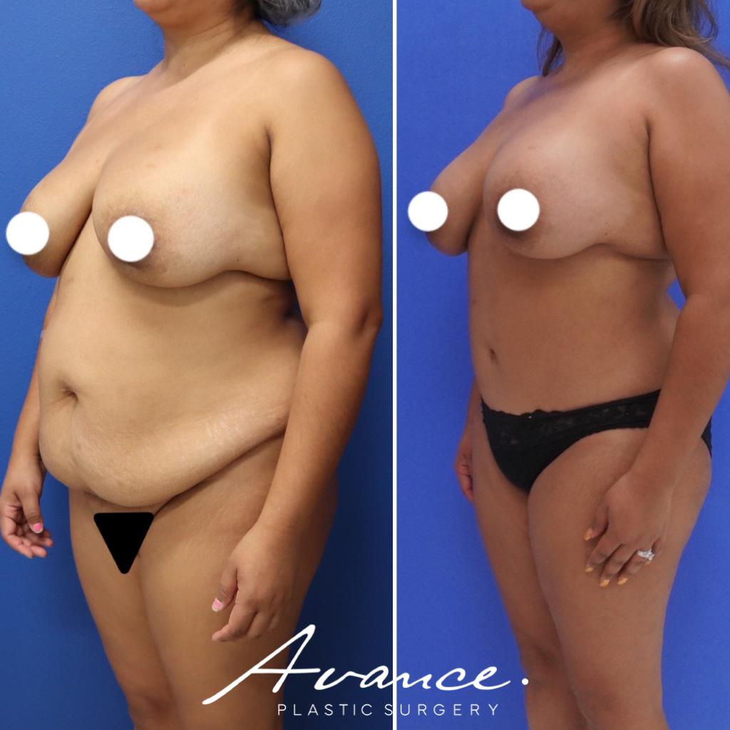Before and After - Abdominoplasty