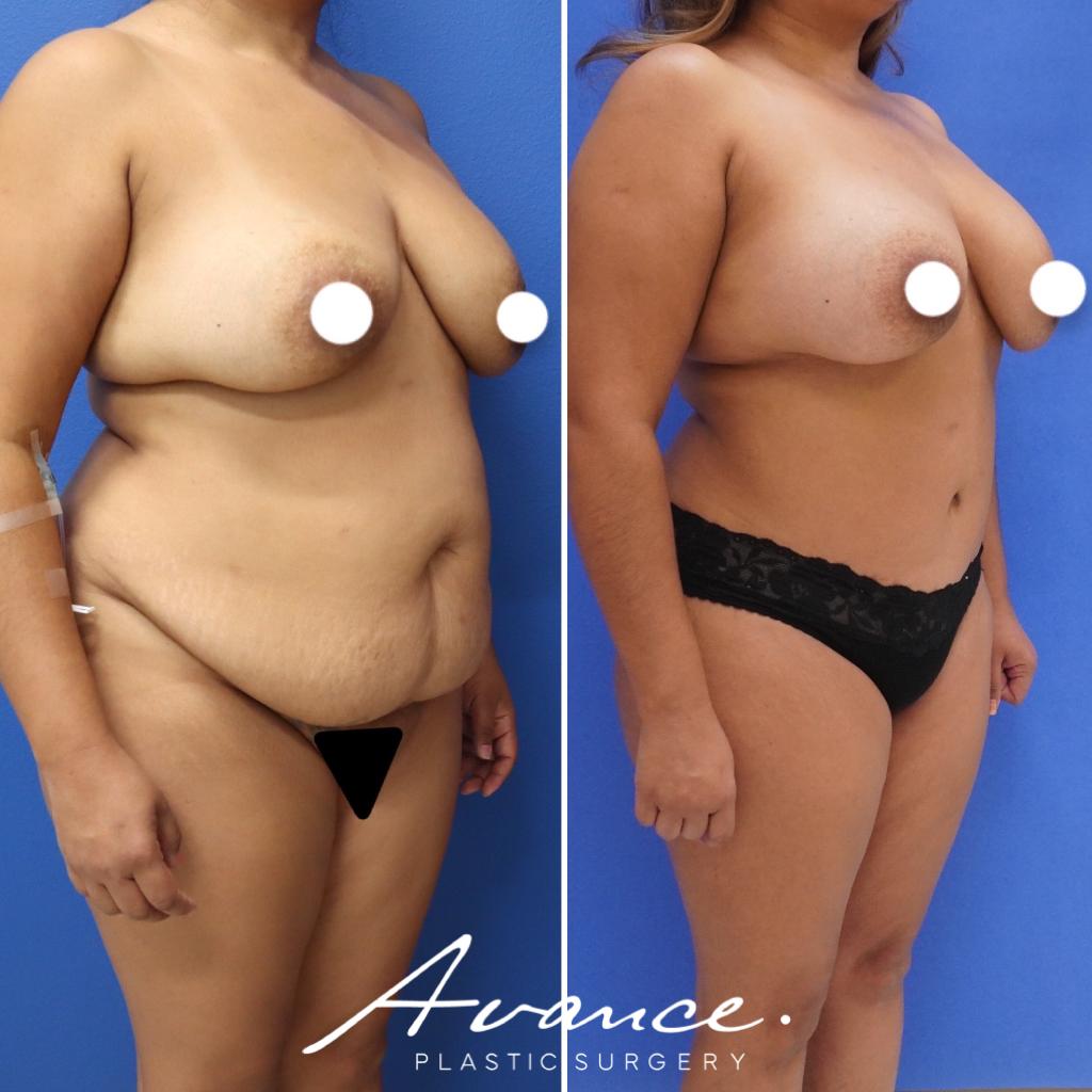 Before and After - Abdominoplasty