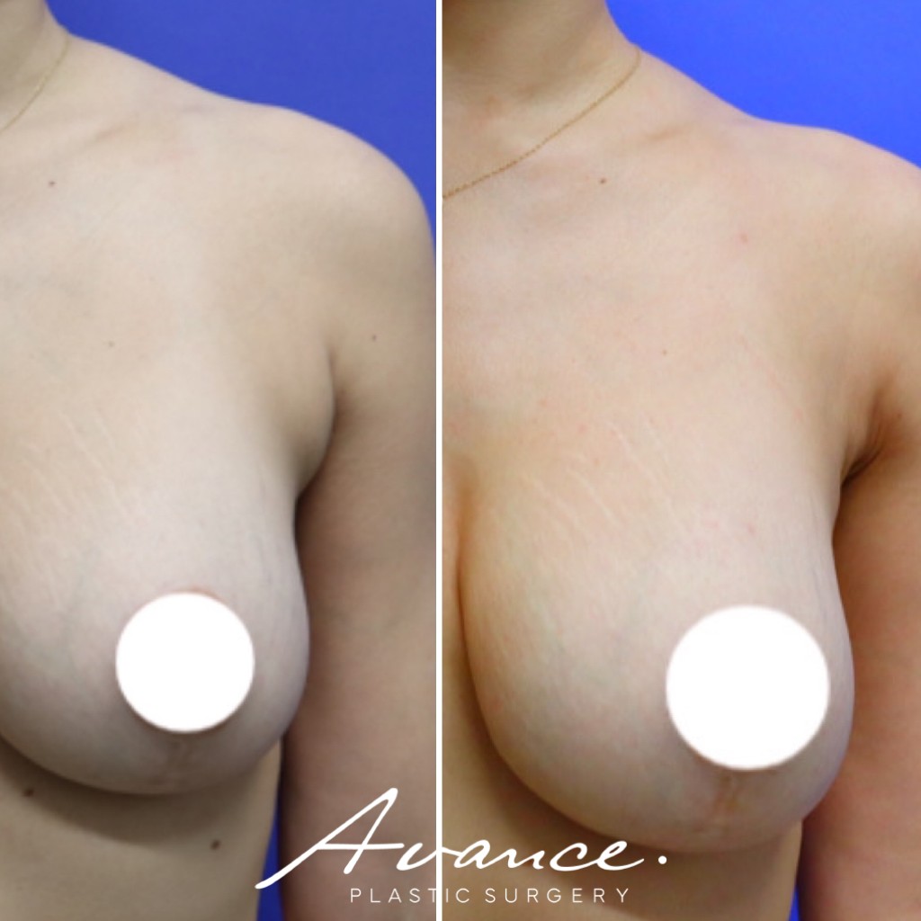 Before and After - Axillary Roll/Bra Roll
