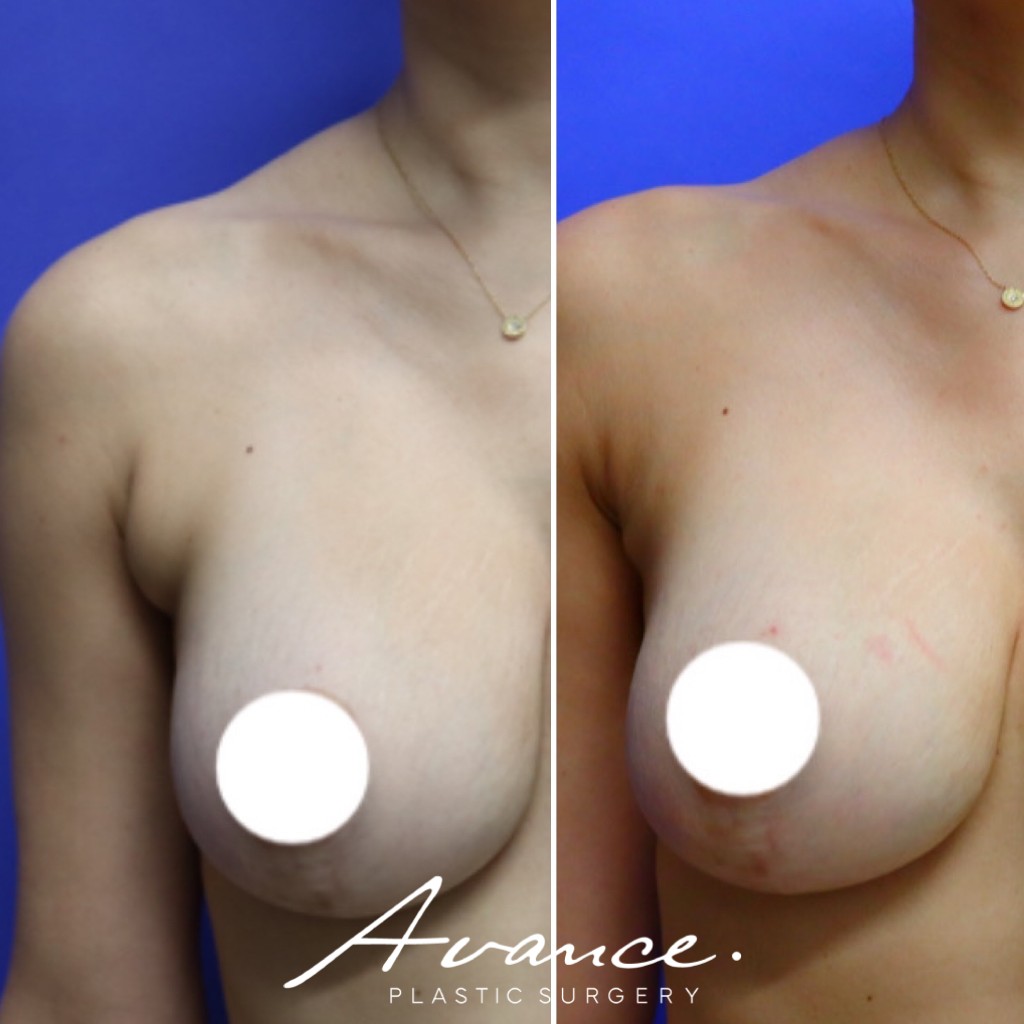 Before and After - Axillary Roll/Bra Roll