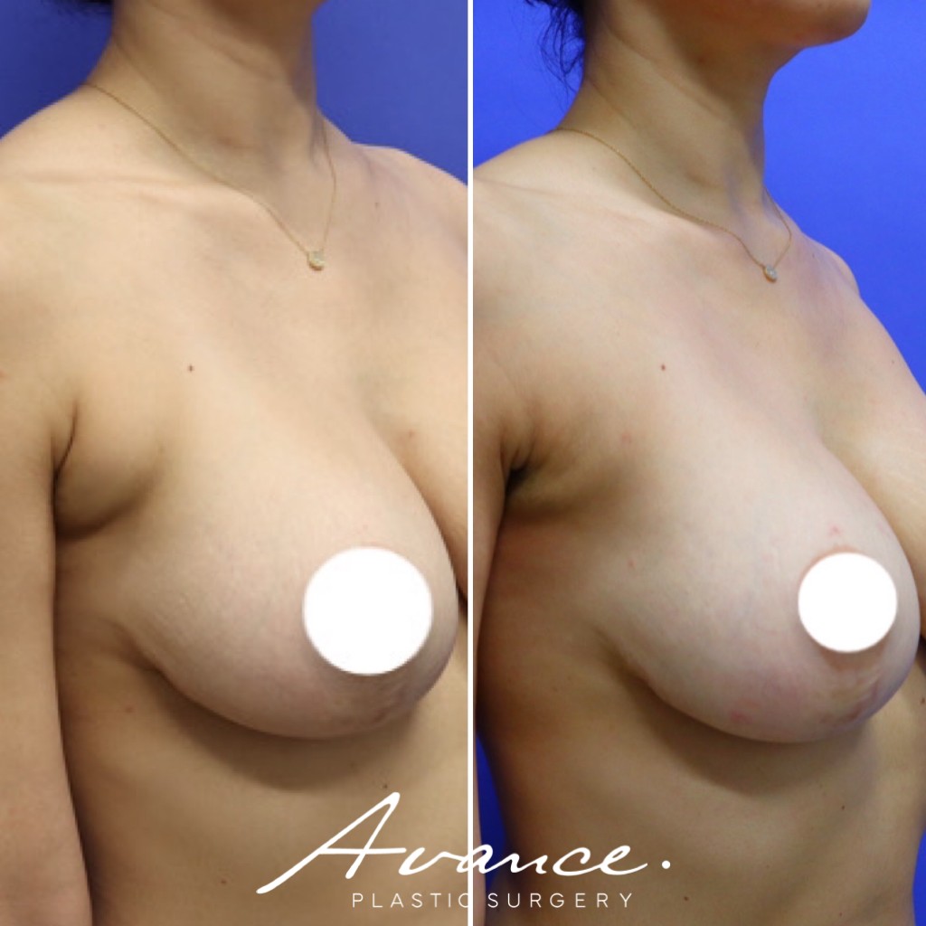 Before and After - Axillary Roll/Bra Roll