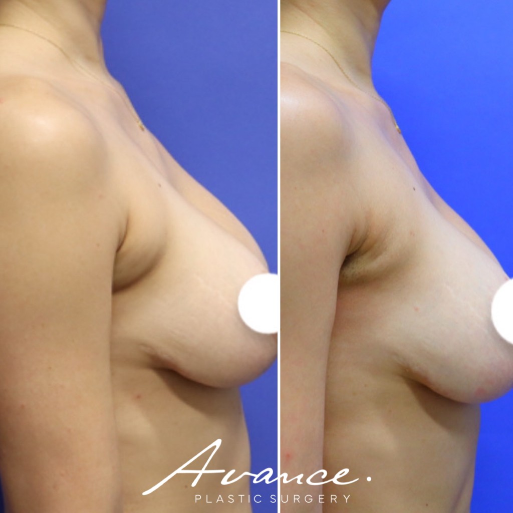 Before and After - Axillary Roll/Bra Roll