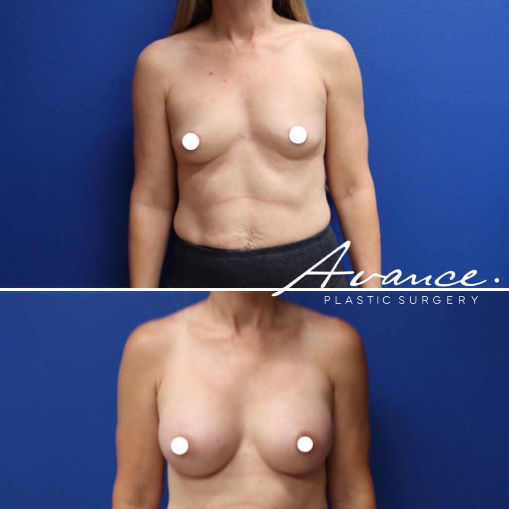 Before and After - Aumento de pecho