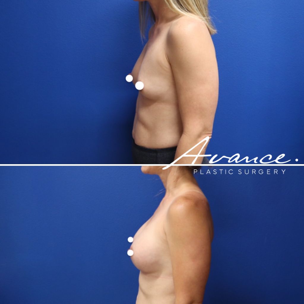 Before and After - Aumento de pecho
