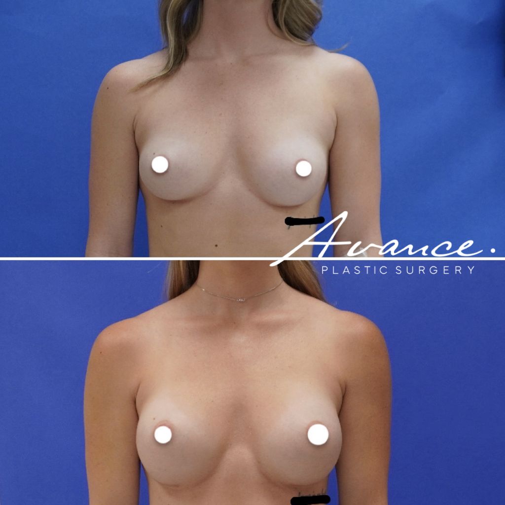 Before and After - Aumento de pecho