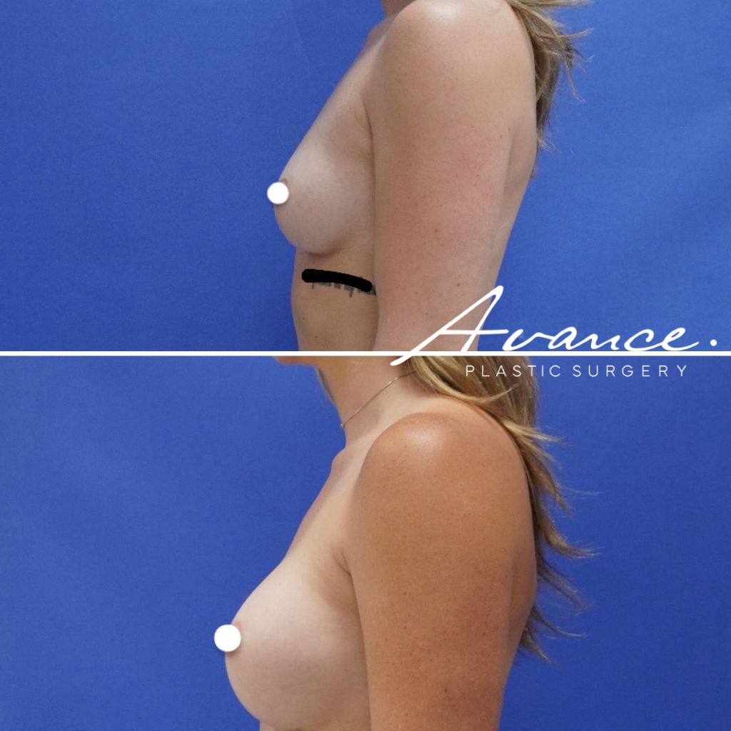 Before and After - Aumento de pecho