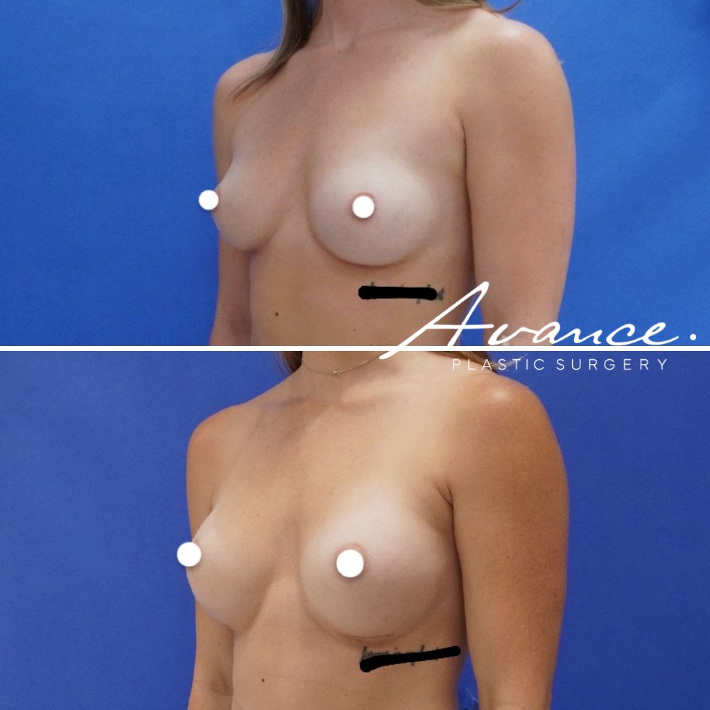 Before and After - Aumento de pecho