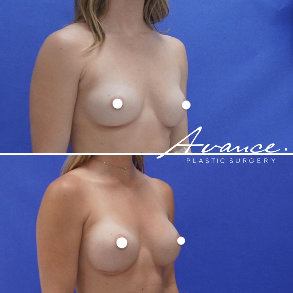 Before and After - Aumento de pecho