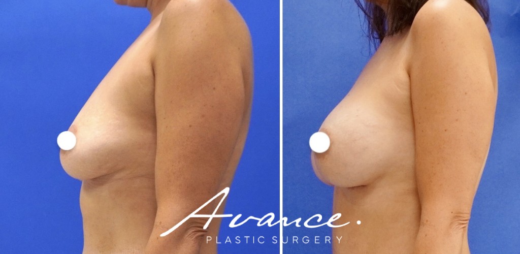 Before and After - Aumento de pecho