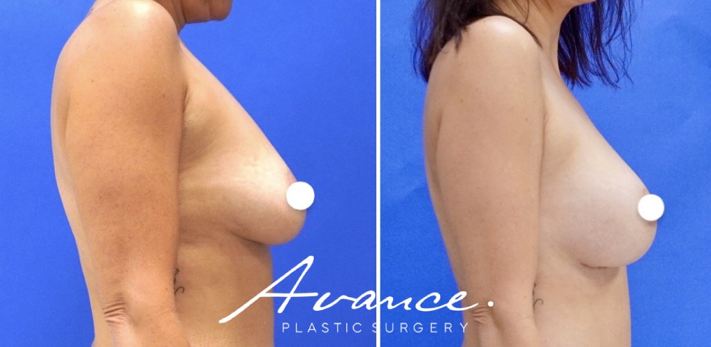 Before and After - Aumento de pecho