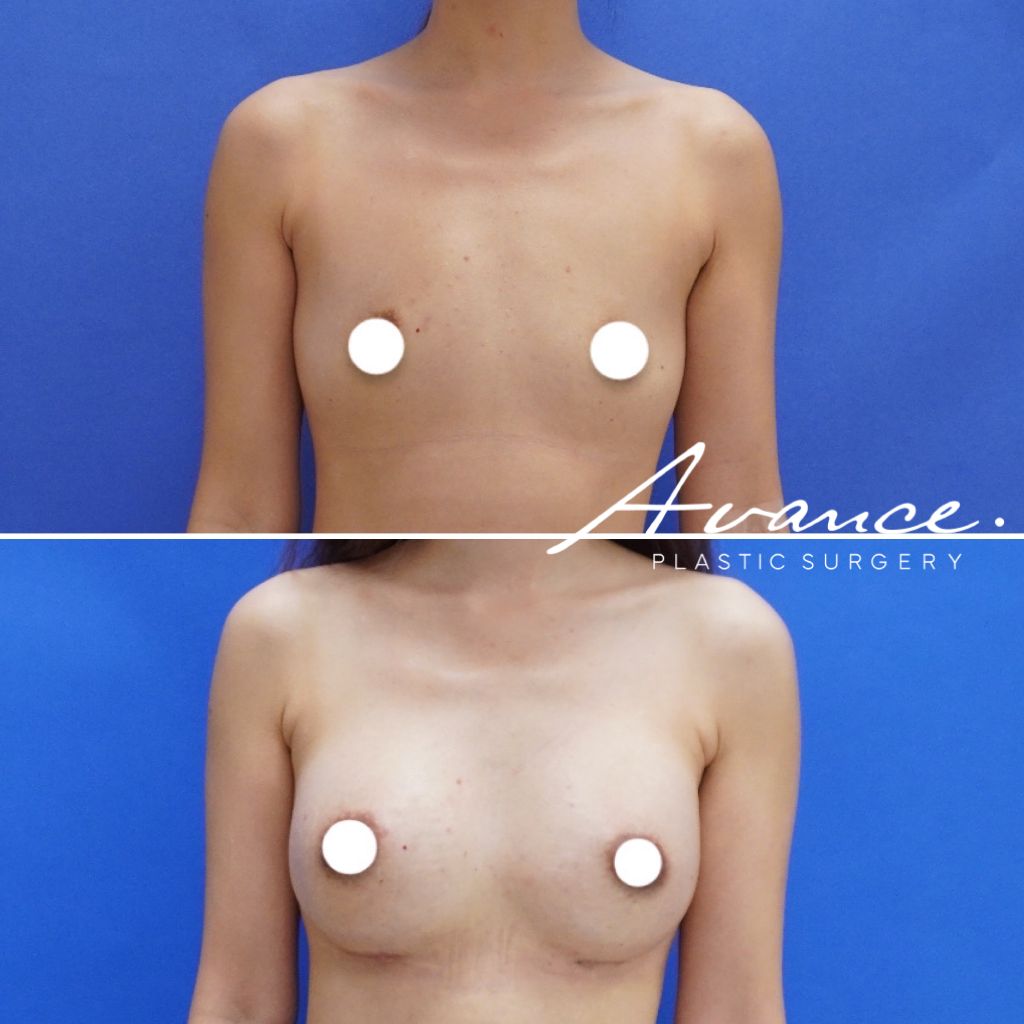 Before and After - Aumento de pecho