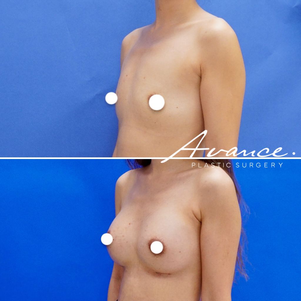Before and After - Aumento de pecho