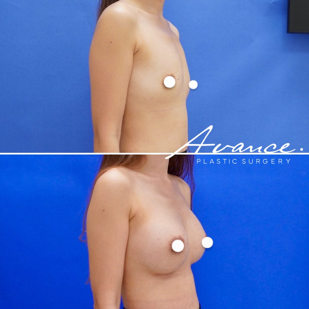 Before and After - Aumento de pecho