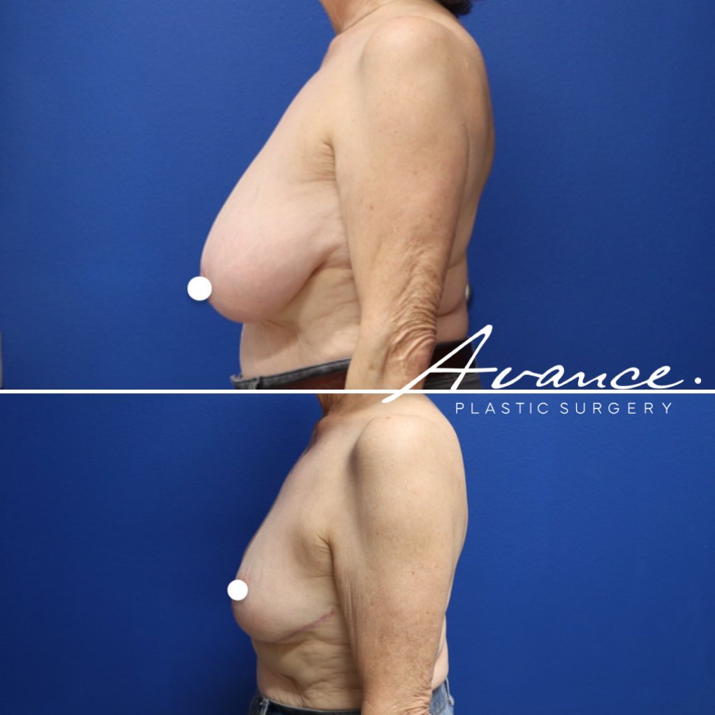 Before and After - Reducción de mamas