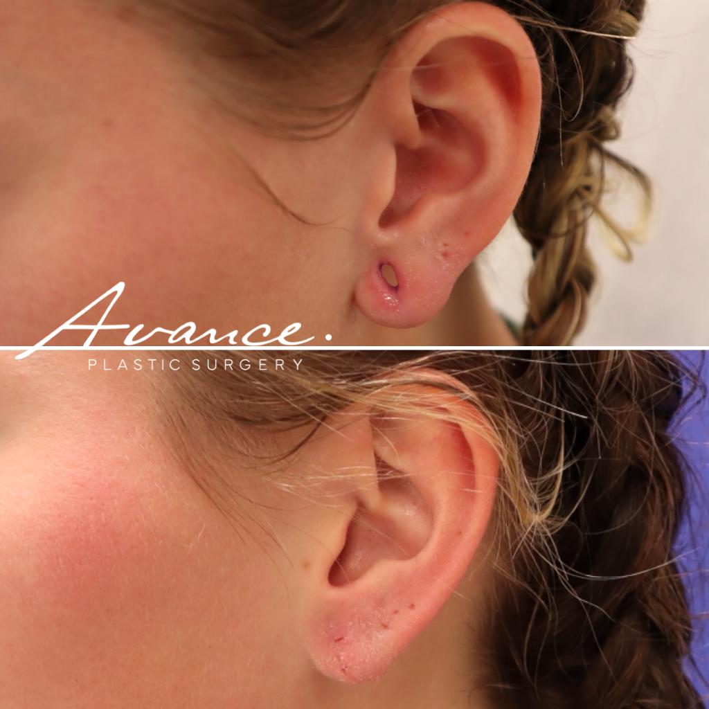 Before and After - Reparación de dilatación de oreja/reducción del lóbulo de la oreja