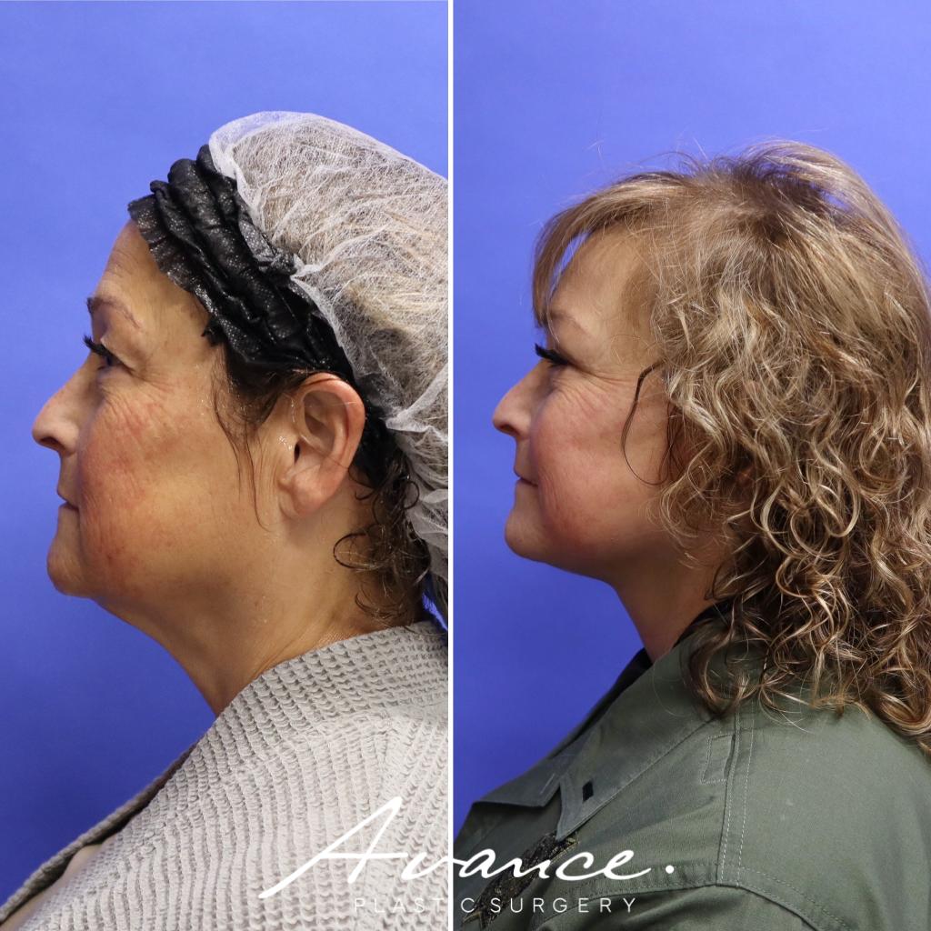 Before and After - Mini Face/Necklift