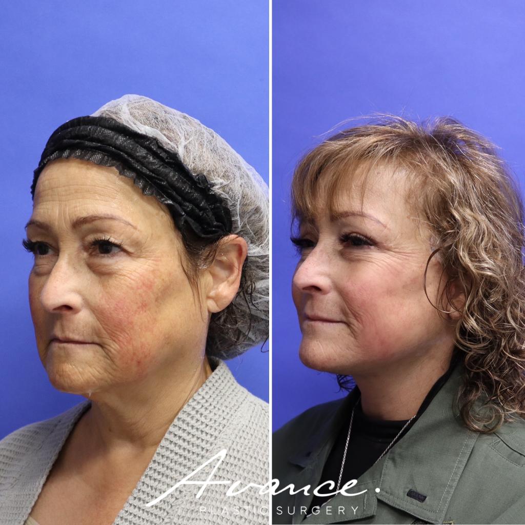 Before and After - Mini Face/Necklift