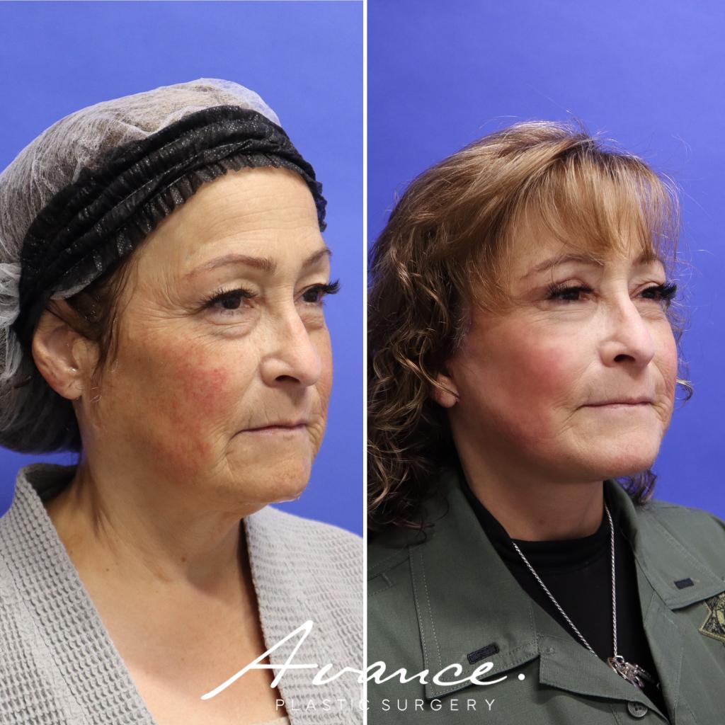 Before and After - Mini Face/Necklift