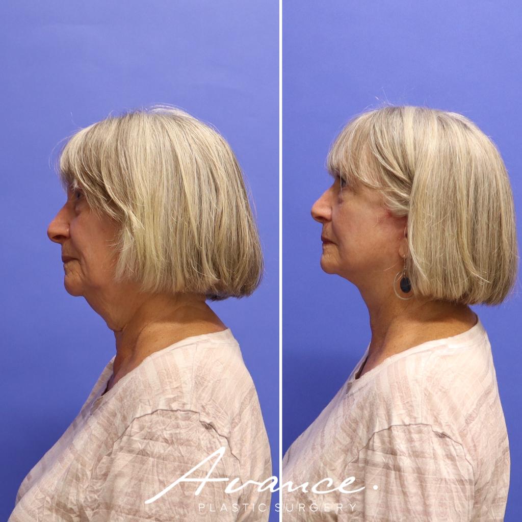 Before and After - Mini Face/Necklift