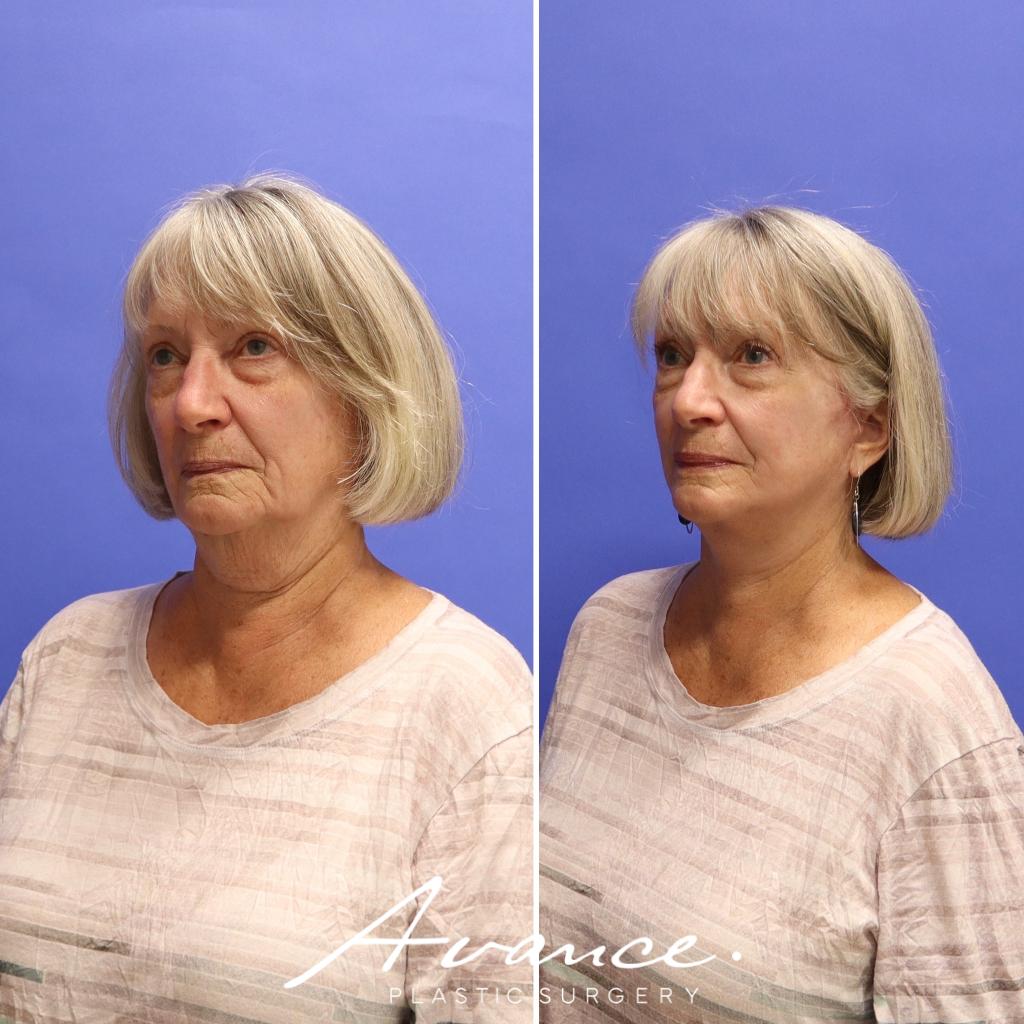Before and After - Mini Face/Necklift