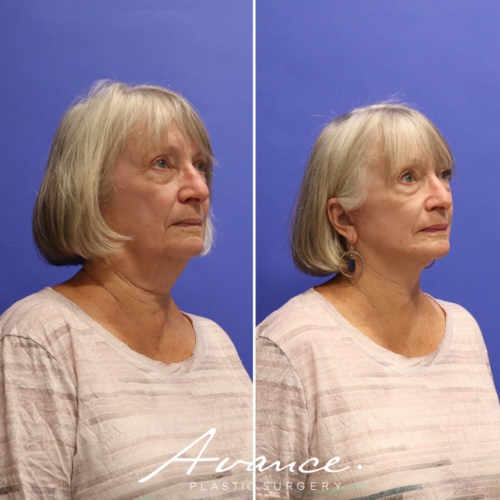 Before and After - Mini Face/Necklift