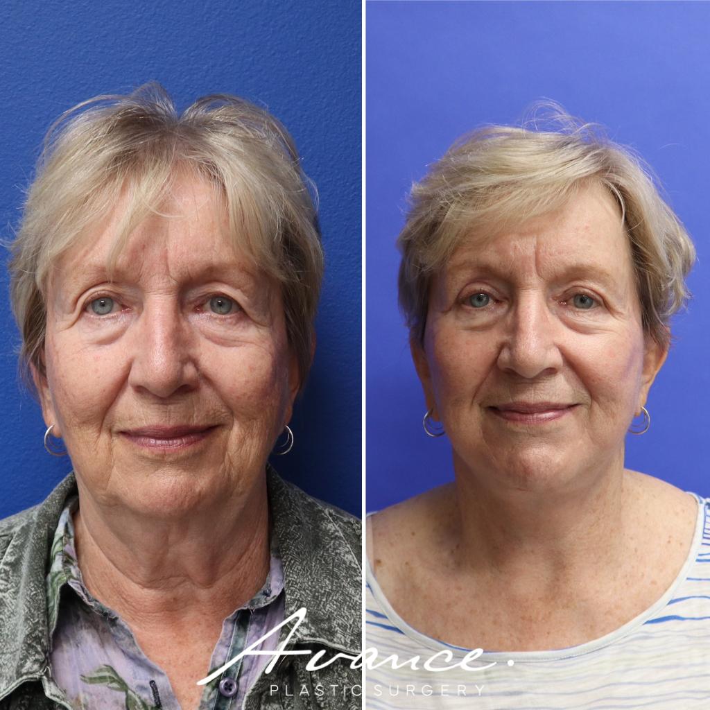 Before and After - Mini Face/Necklift