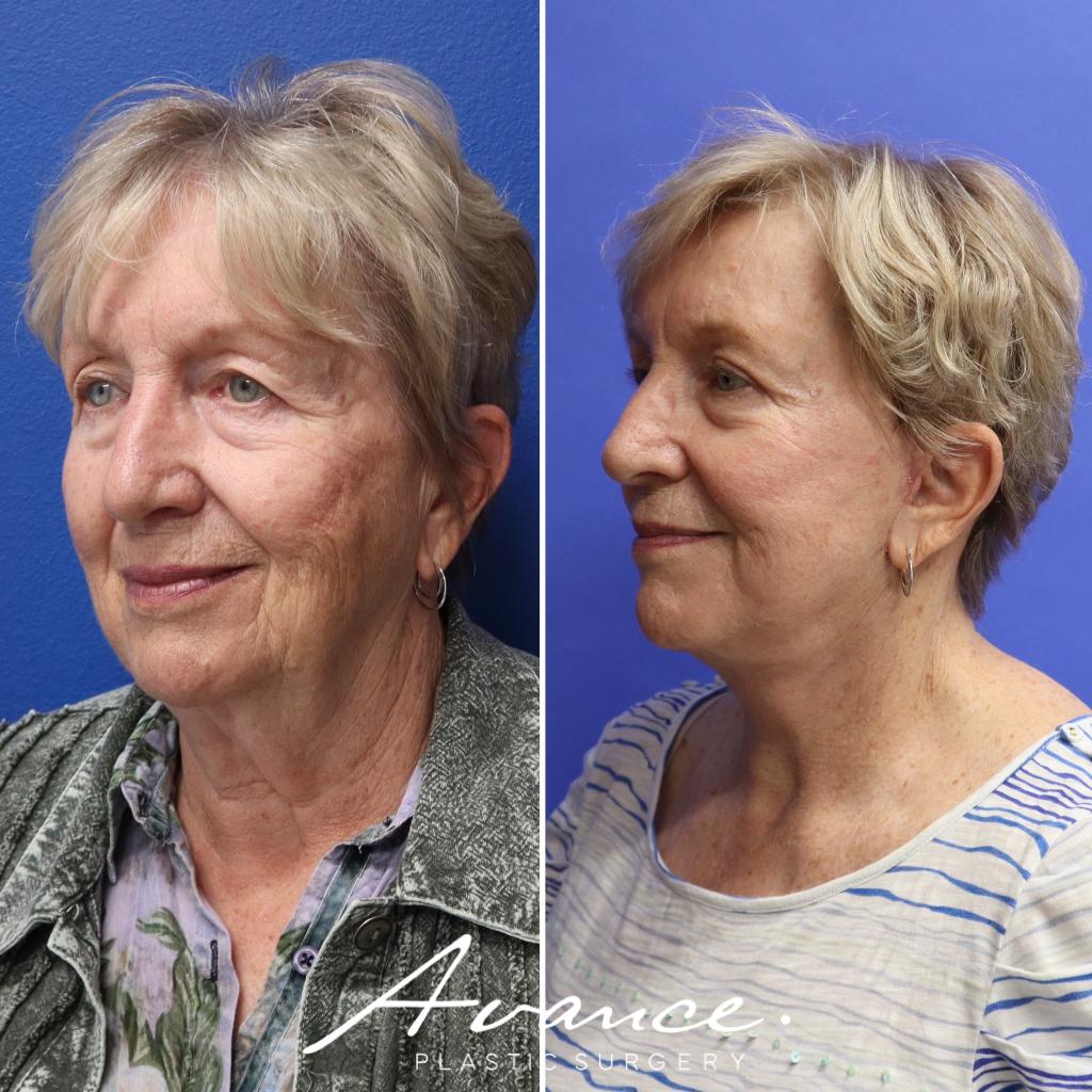 Before and After - Mini Face/Necklift