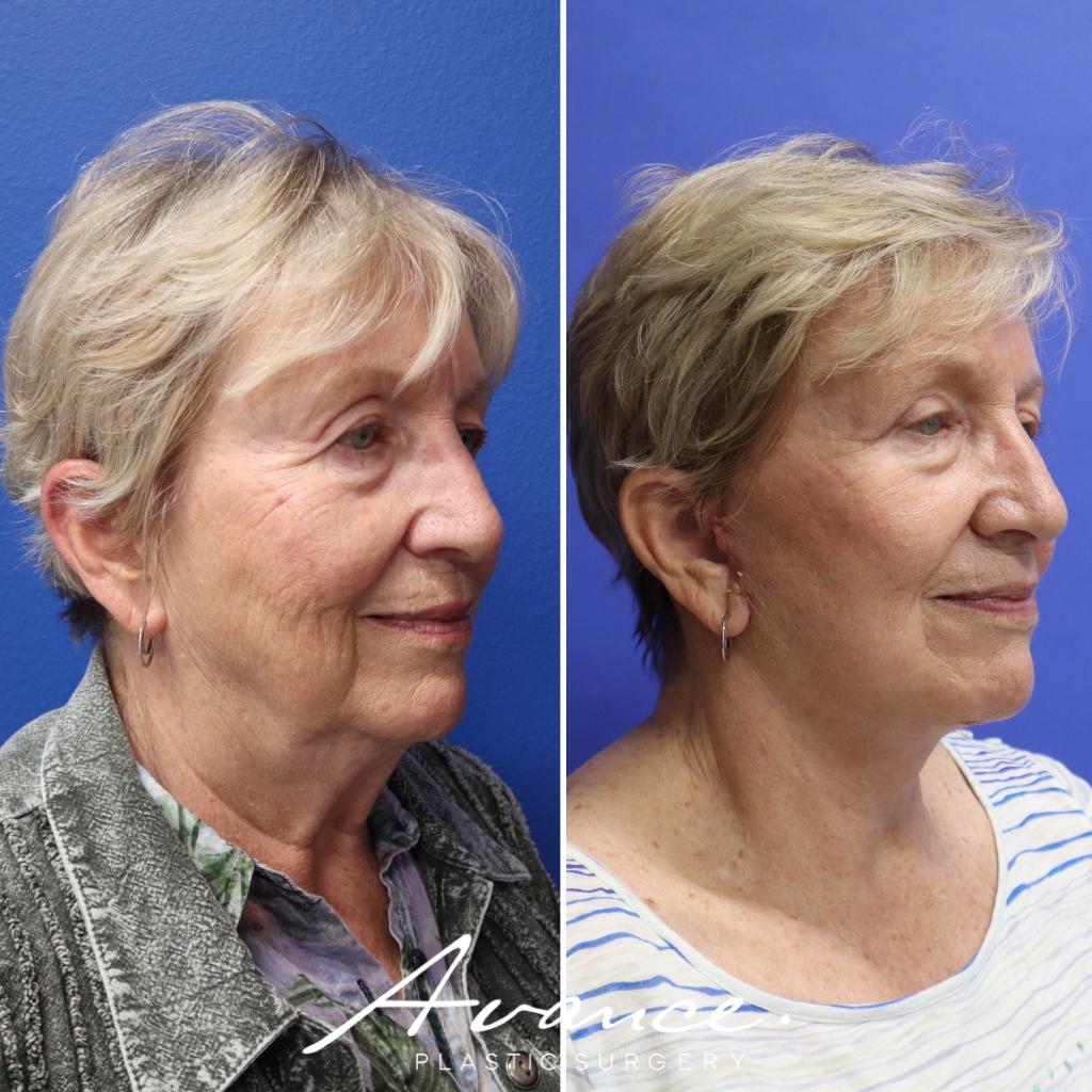 Before and After - Mini Face/Necklift