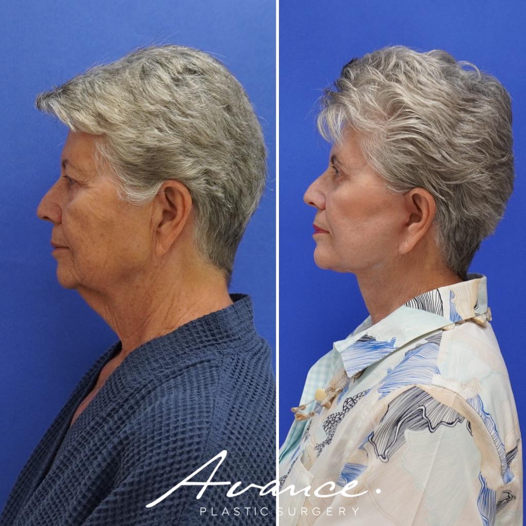 Before and After - Mini Face/Necklift