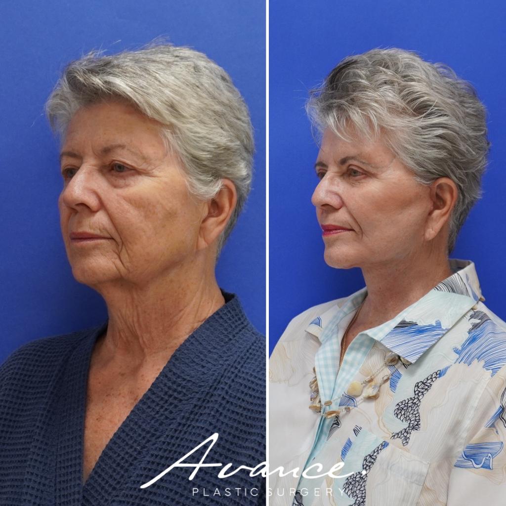Before and After - Mini Face/Necklift