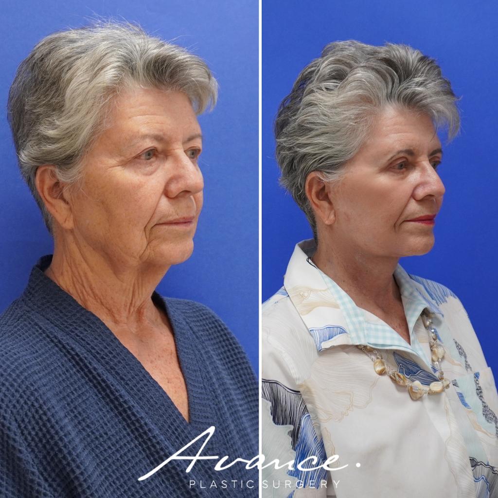 Before and After - Mini Face/Necklift