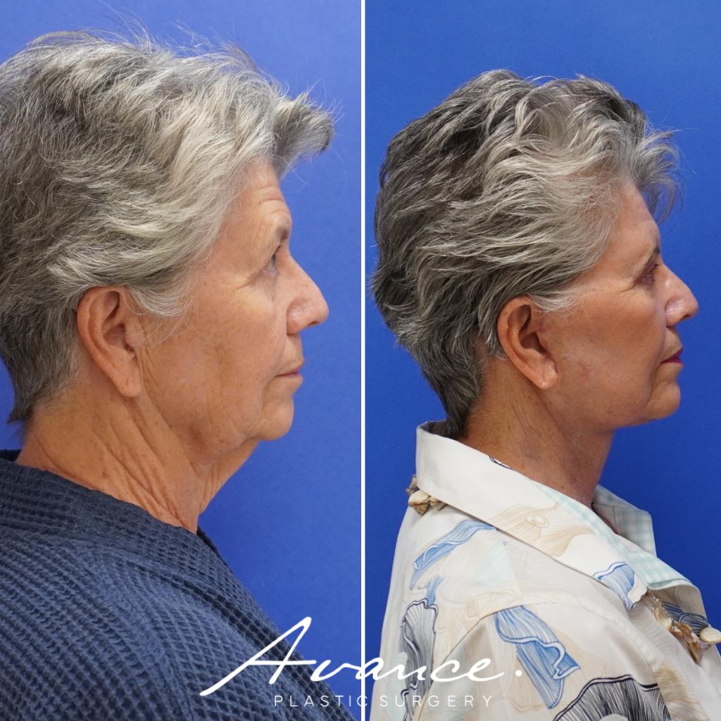 Before and After - Mini Face/Necklift