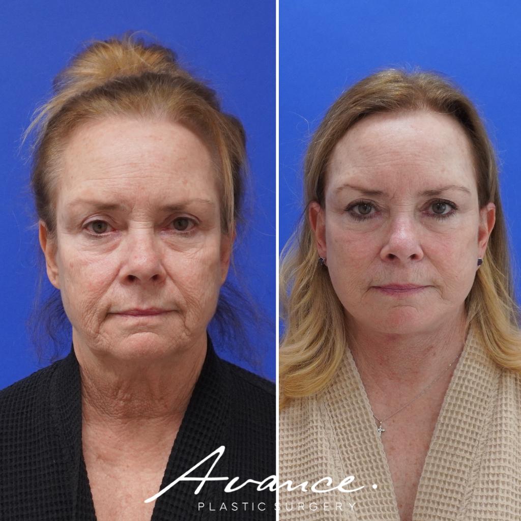 Before and After - Mini Face/Necklift
