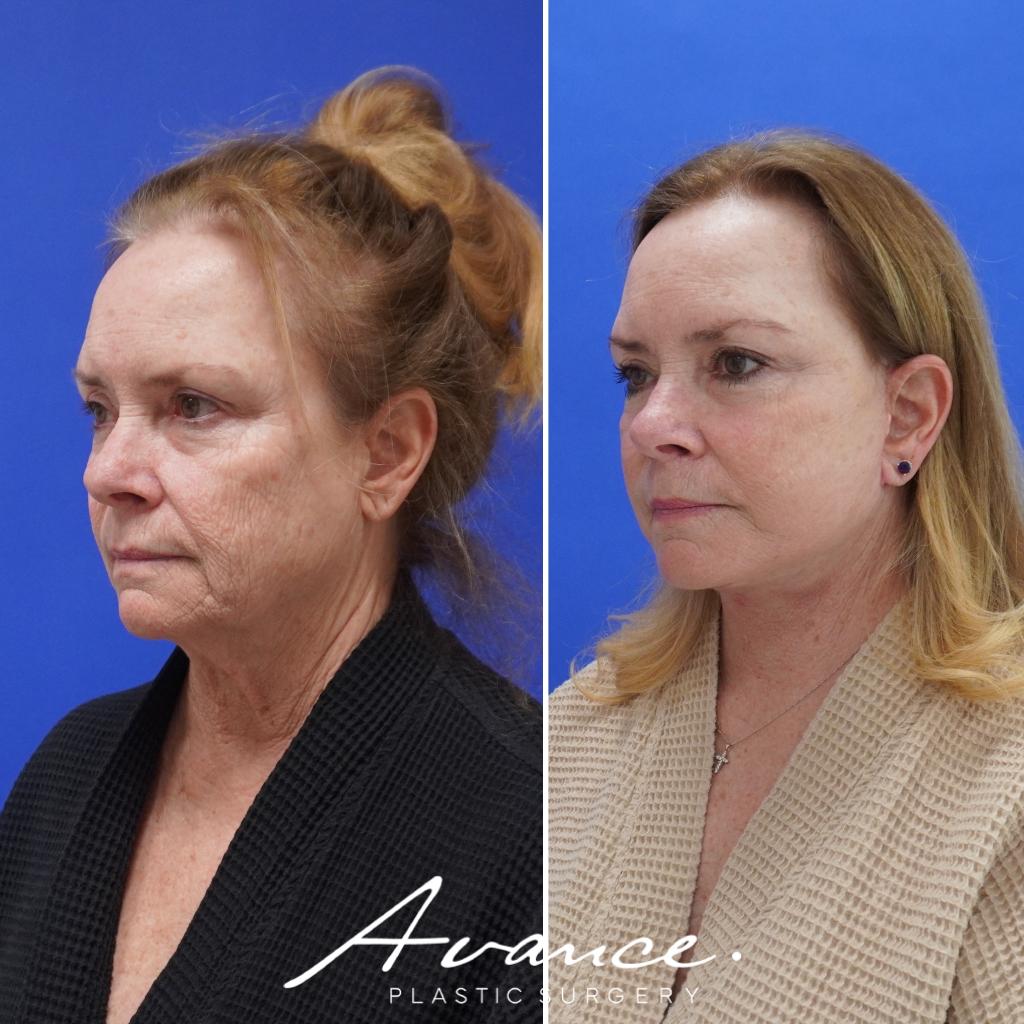 Before and After - Mini Face/Necklift