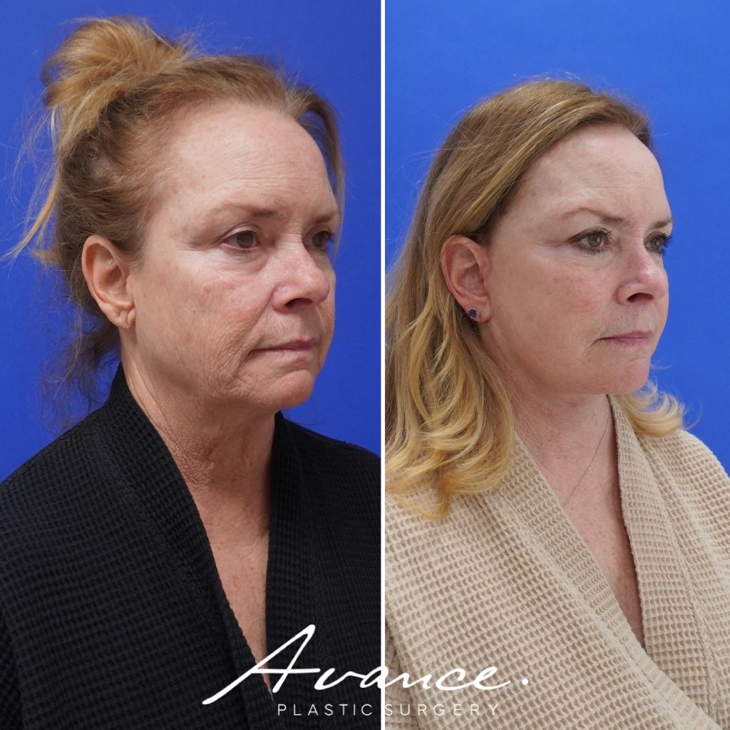 Before and After - Mini Face/Necklift